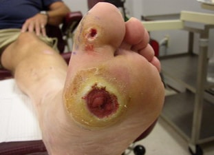 1758670152_foot-ulcer-1-copy Diabetic Foot Ulcer Treatment in Phoenix & Glendale, AZ