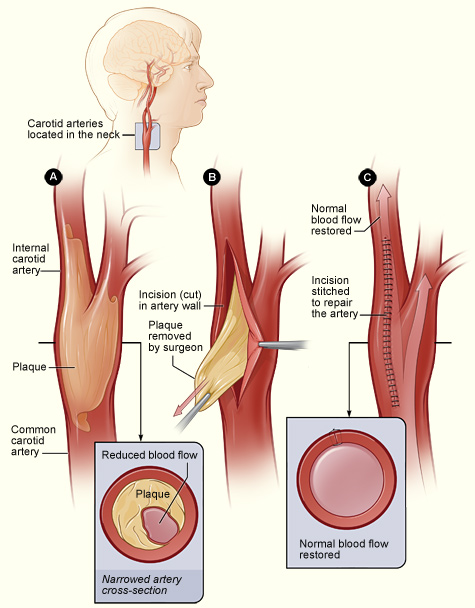 The Symptoms Of Carotid Artery Disease