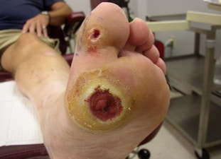 up close of bottom of foot with ulcers on ball and big toe
