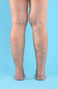 varicose veins treated vein ablation to improve circulation