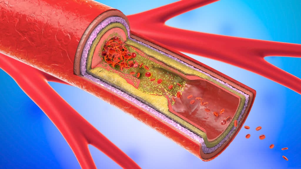 illustrated cross section of blocked artery