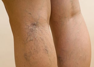 treating spider veins dr. zakhary glendale, az