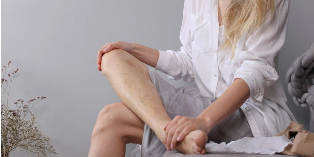 varicose vein laser surgery recovery and prevention compression picture id1206696871