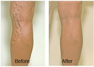 vein ablation before and after images dr zakhary glendale az