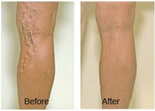 pair of legs before and after vein ablation with varicose veins removed after treatment