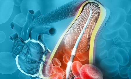 angioplasty illustration