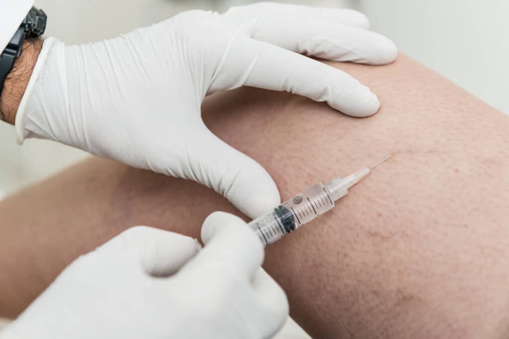 Sclerotherapy to treat spider veins