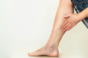 Varicose veins on the womans legs