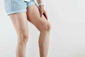 Woman with tired painful and spider varicose veins