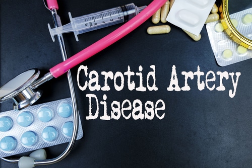 Carotid Artery Disease medical concept
