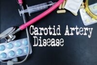 Carotid Artery Disease medical concept